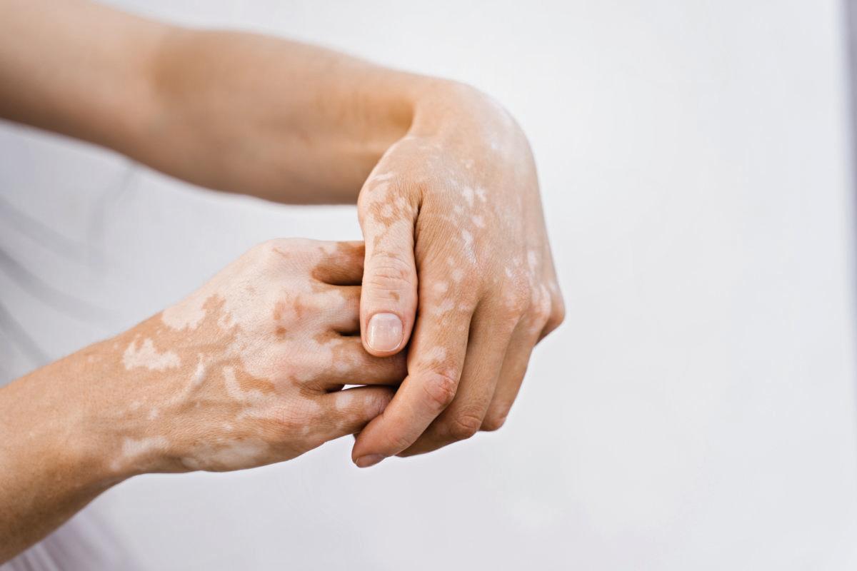 Hände mit Vitiligo-Hautpigmentierung auf weißem Hintergrund in Nahaufnahme. Lebensstil mit saisonalen Hautkrankheiten