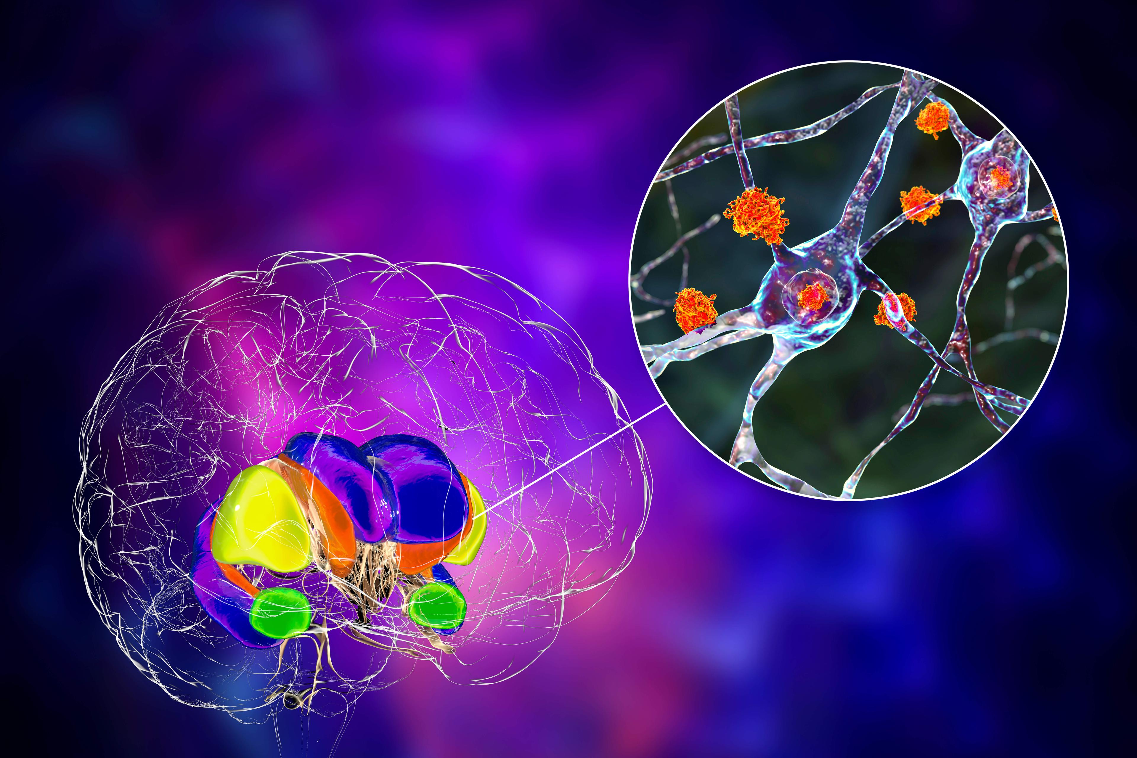 Dorsales Striatum und seine Neuronen bei der Huntington-Krankheit, 3D-Illustration