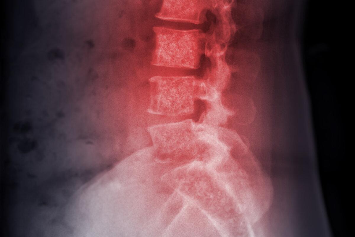 Röntgenbild der lambosakralen Wirbelsäule oder L-S-Wirbelsäule mit Knochenmetastasen.
