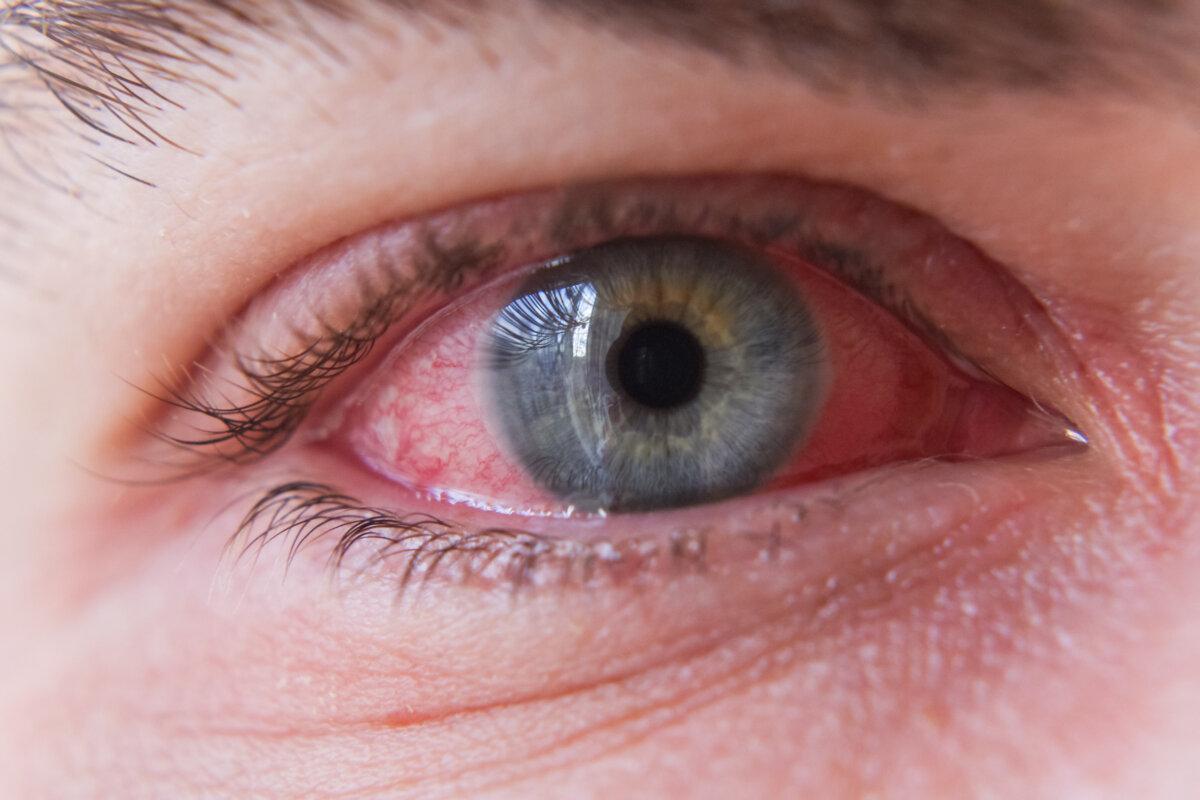 Makro-Nahaufnahme eines roten Auges mit Bindehautentzündung