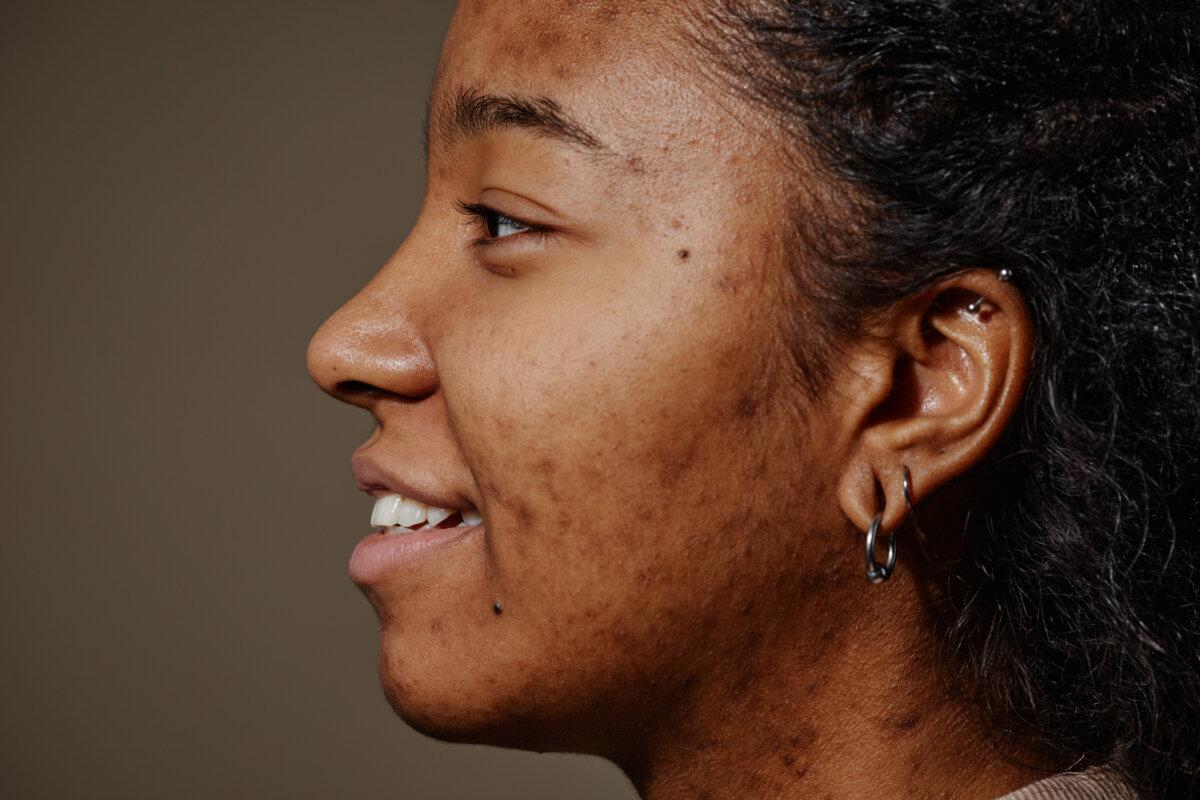 Nahaufnahme des Porträts einer lächelnden schwarzen Frau mit Aknenarben im Gesicht, Fokus auf echte Hautstruktur,