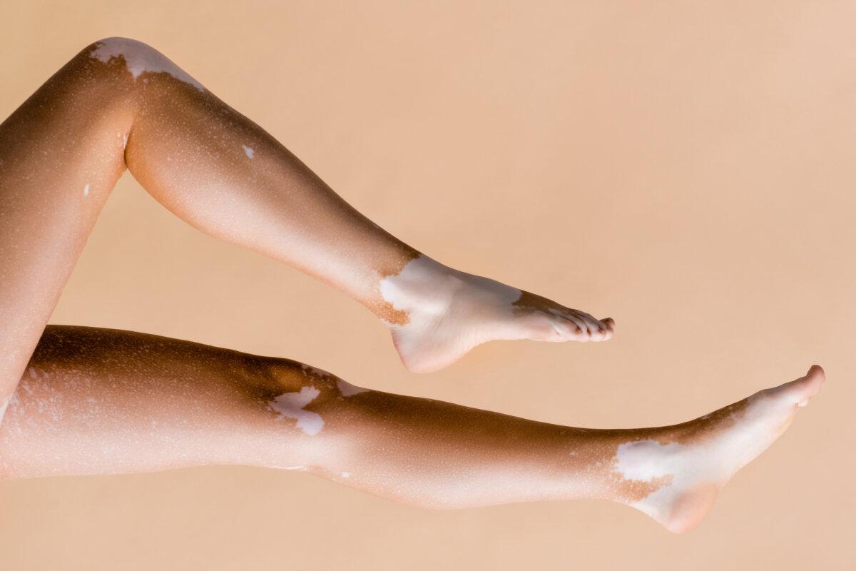 Ausgeschnittene Ansicht weiblicher Beine mit Vitiligo isoliert auf Beige