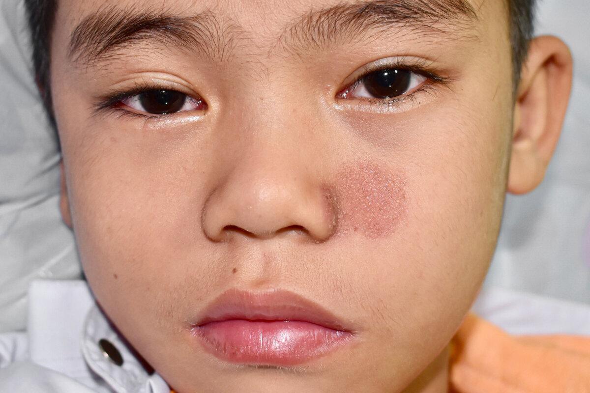 Tinea faciei oder Pilzinfektion im Gesicht eines zweijährigen südostasiatischen, burmesischen Kindes
