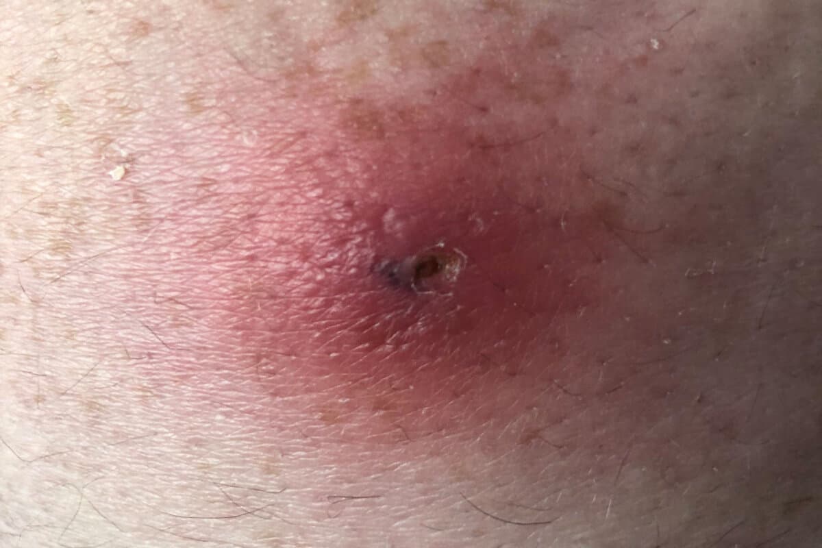 wiki_Myiasis_papule_furuncle_caused_by_cordylobia_anthropophaga