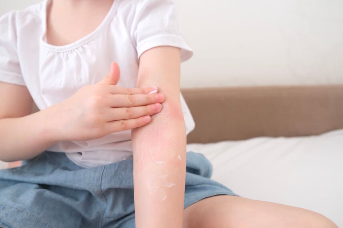 Bei Kindern, jungen und älteren Erwachsenen kann die atopische Dermatitis unterschiedlich aussehen.