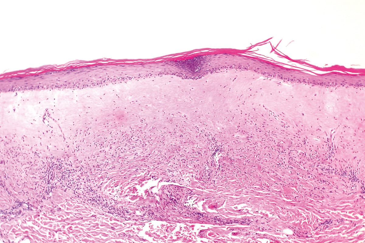 Histologisches Präparat eines Lichen sclerosus (atrophische Form).