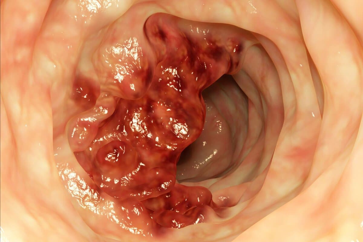 Die Integration von Tumordeposits in die TNM-Klassifikation könnte beim Kolonkarzinom von Vorteil sein.