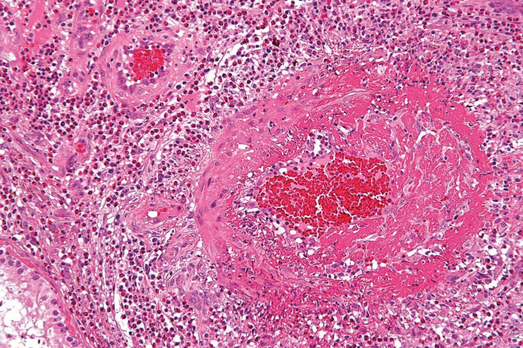 Eosinophile Granulomatose mit Polyangiitis (EGPA), früher Churg-Strauss-Syndrom