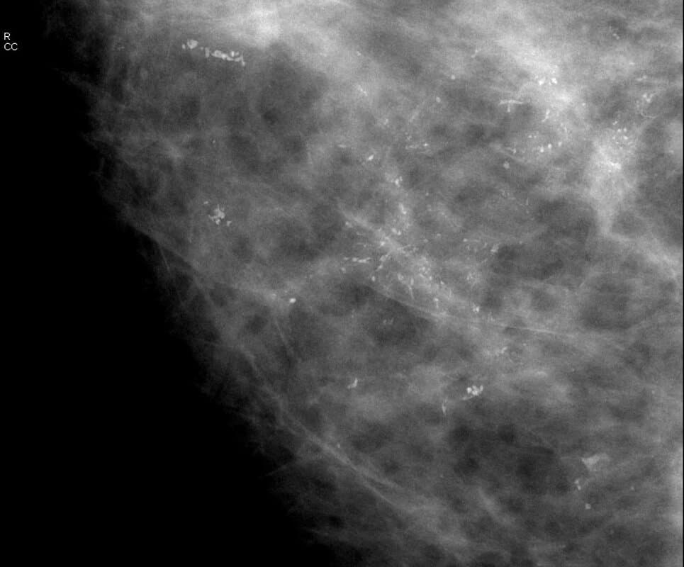 DCIS ductal carcinoma in situ. Spot magnification CC digital mammogram view of right breast in a 51 year old patient reveals extensive microcalcifications in the anterior/superior aspect of the lower inner quadrant of the right breast. Pathologic diagnosis revealed malignant comedo type intraductal carcinoma high grade with necrosis and calcifications. Cannot rule out microinvasion.