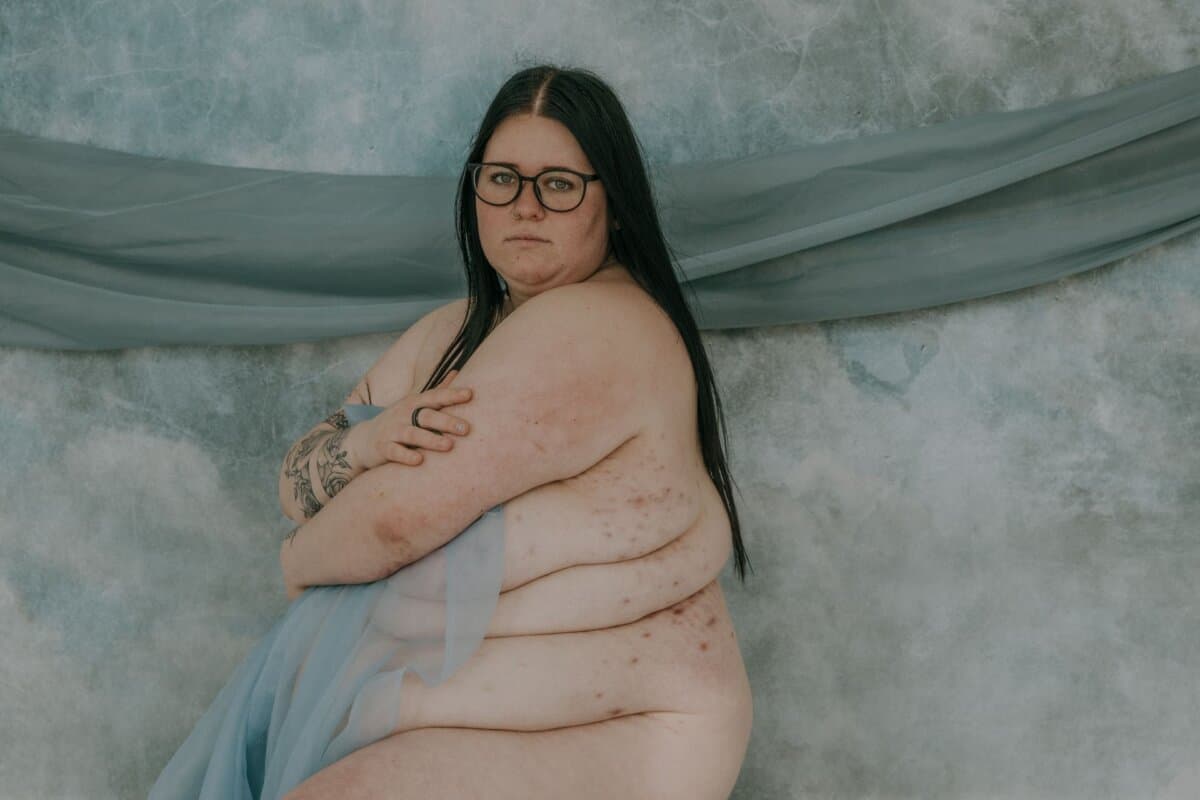 Hauterkrankungen begünstigen Depressionen. Für die Hidradenitis suppurativa fand eine Forschergruppe nun auch ein erhöhtes Suizid-Risiko.
