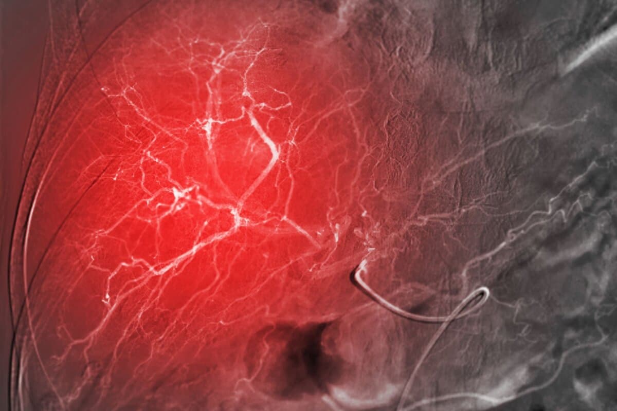 Bei der TACE werden Chemotherapeutika direkt in den Lebertumor eingebracht.