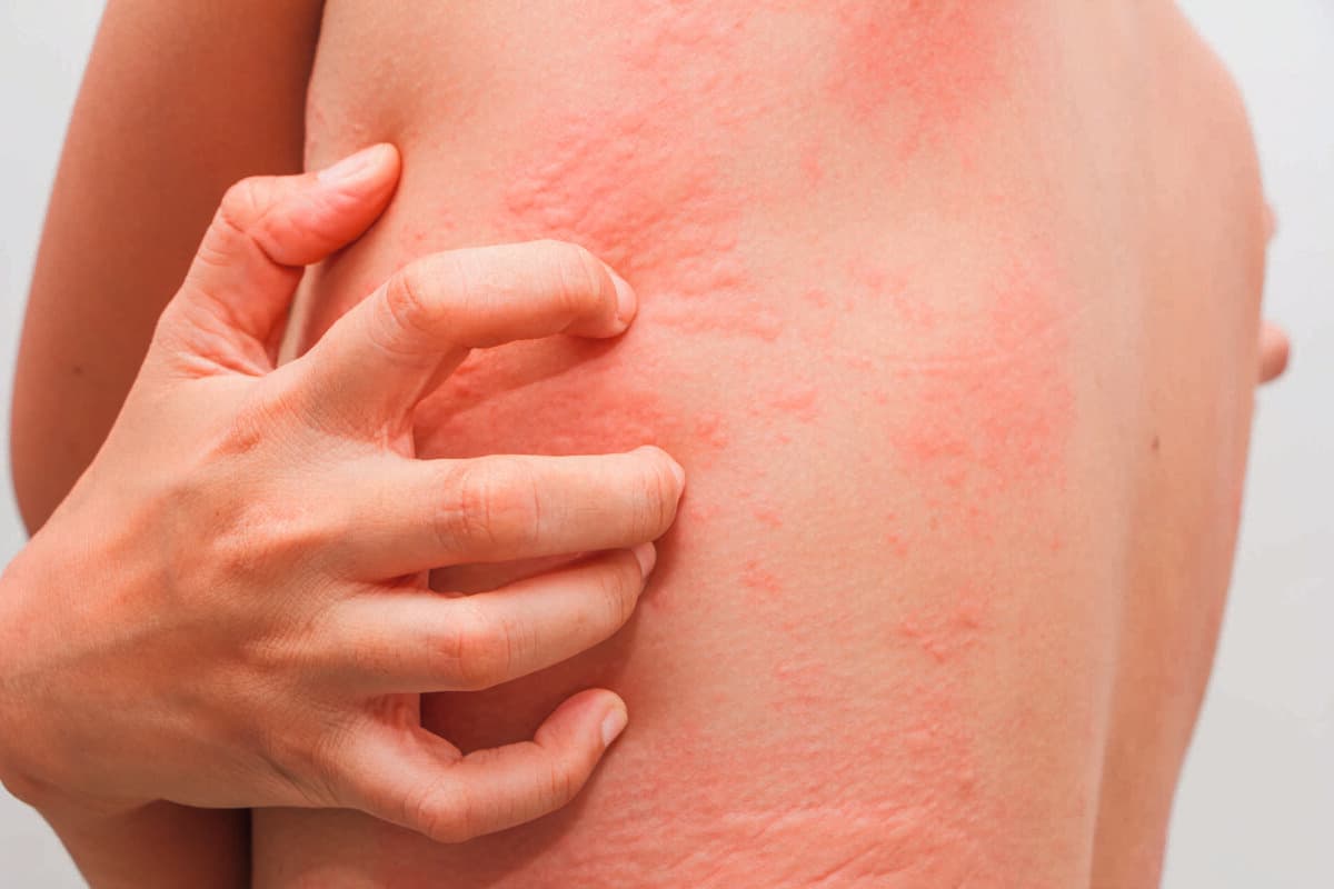 Frauen mit Symptomen einer juckenden Urtikaria.