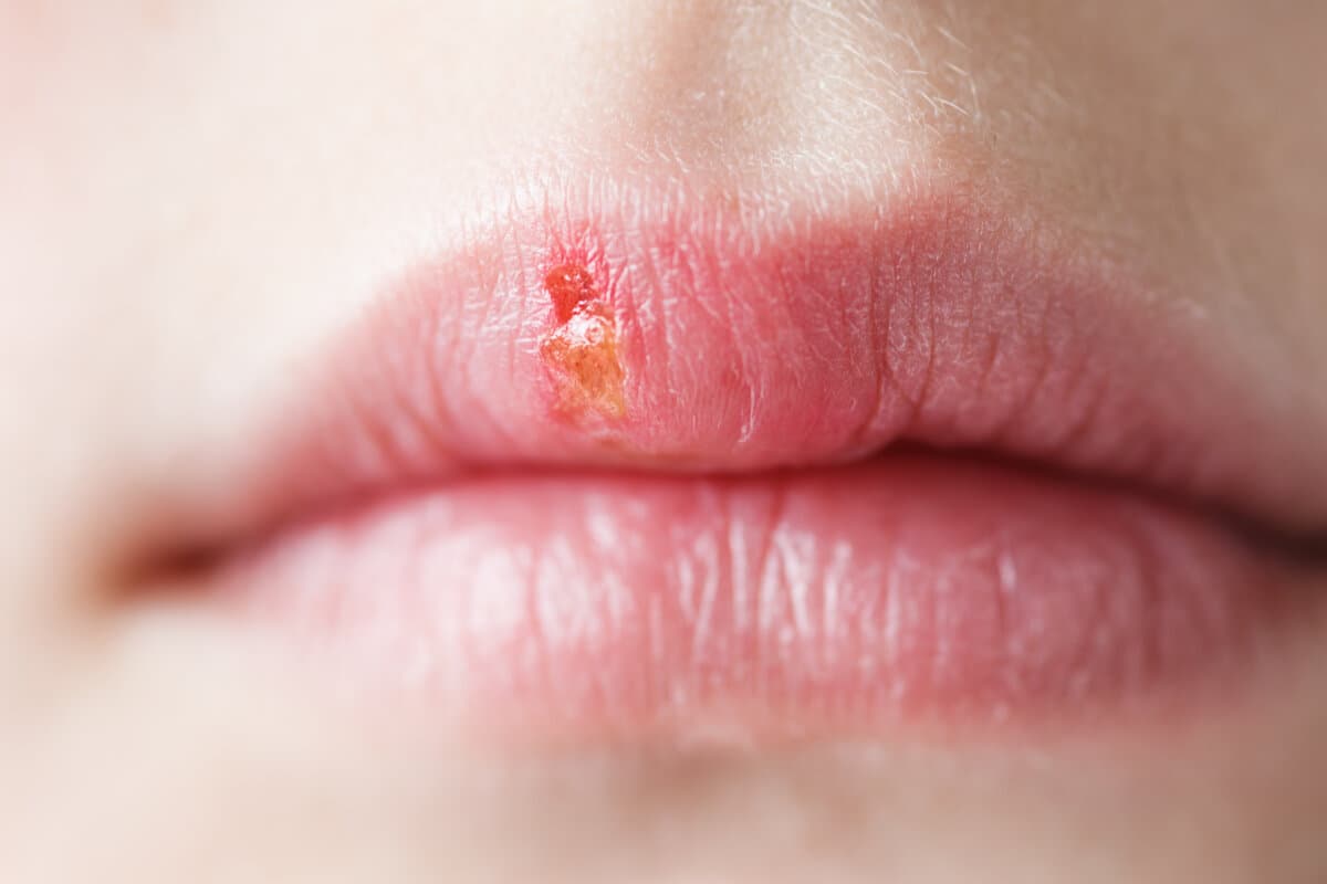 Nahaufnahme der Lippen mit Herpes-simplex-Infektion