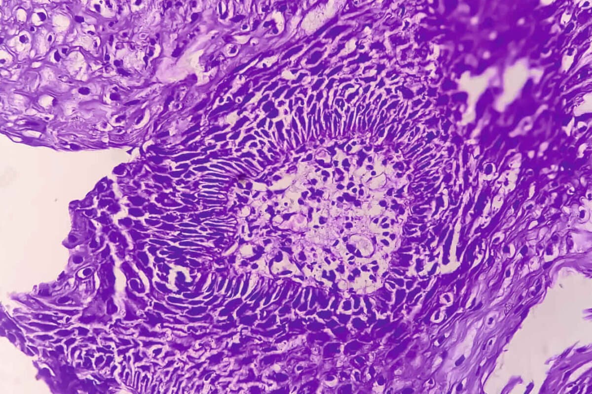 Atezolizumab + mFOLFOX6 halbiert das Rezidivrisiko beim dMMR-Kolonkarzinom.