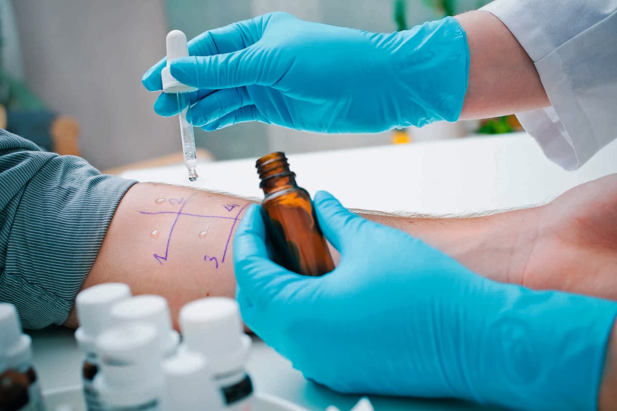 Hautstichallergie zur Bestimmung der Allergieart