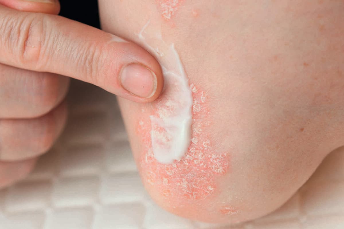 Psoriasis auf der Haut des Ellenbogens einer jungen Frau in einem weißen T