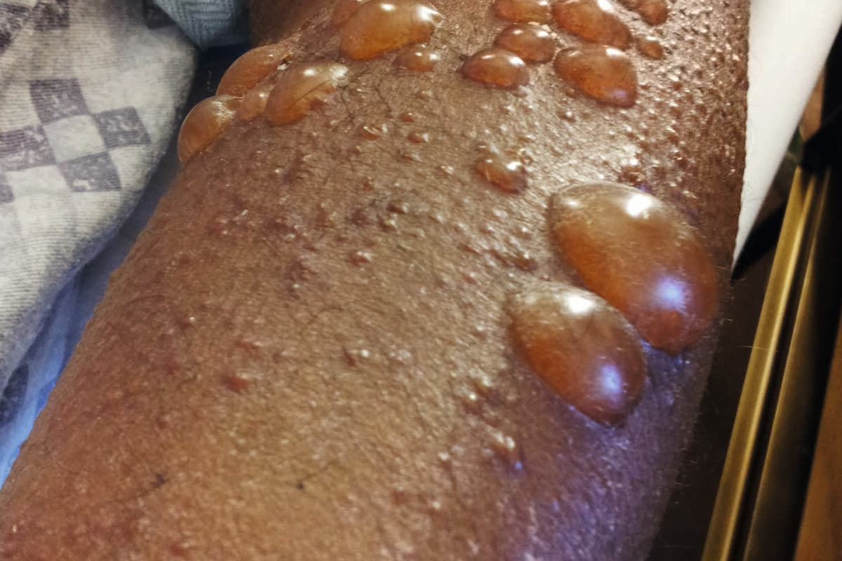 Bullöses Pemphigoid mit dickwandigen Blasen