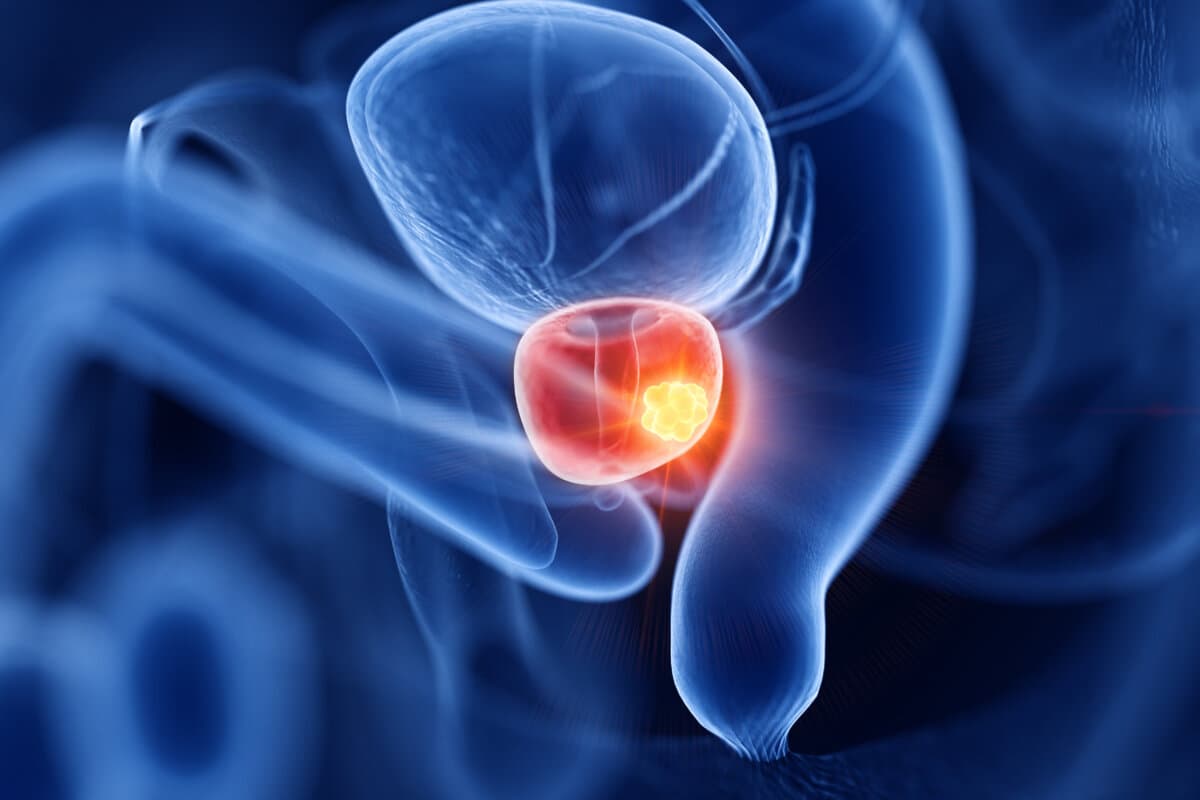 3D-gerenderte medizinisch genaue Darstellung von Prostatakrebs