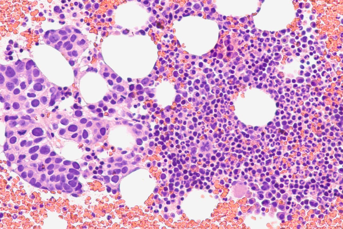 Photomicrograph of a bone marrow biopsy showing involvement by m