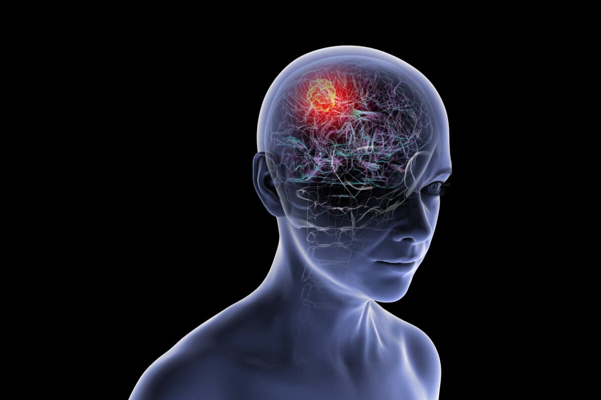 Therapie gegen Hirnmetastasen getestet