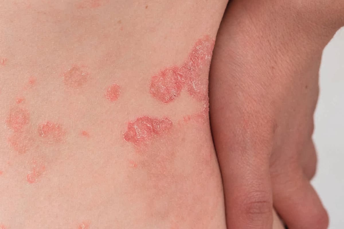 Psoriasis, Psoriasis-Arthritis