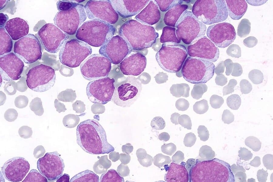 csm_2048px-Acute_Myeloid_Leukemia__M2_type__wiki_commons_2dd7d90016