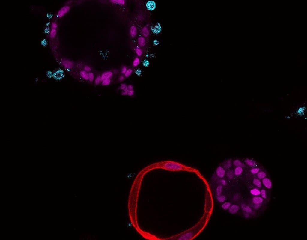 Wie Bauchspeicheldrüsenkrebs die Tumorumgebung vorbereitet: Möglicher Biomarker für früheste Entstehungsphase gefunden