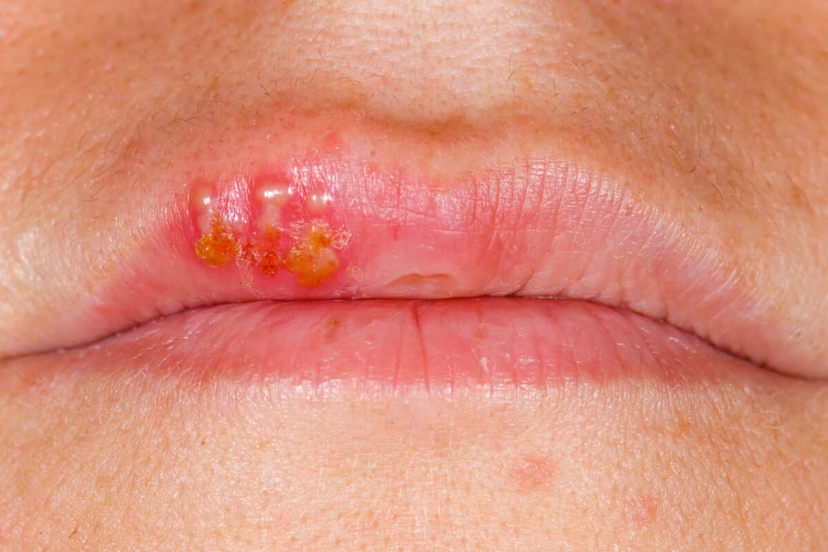 Close up photo of oral herpes simplex virus infection