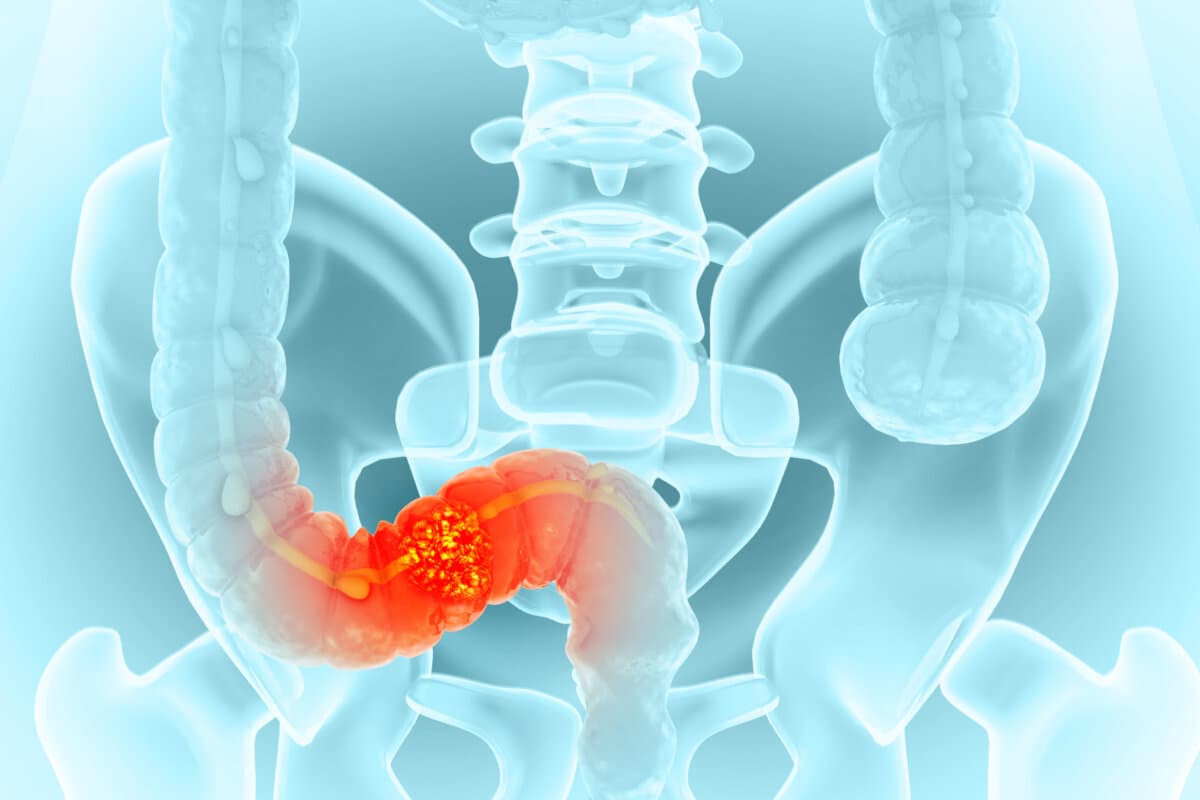 Colon cancer. Colon disease. 3d illustration