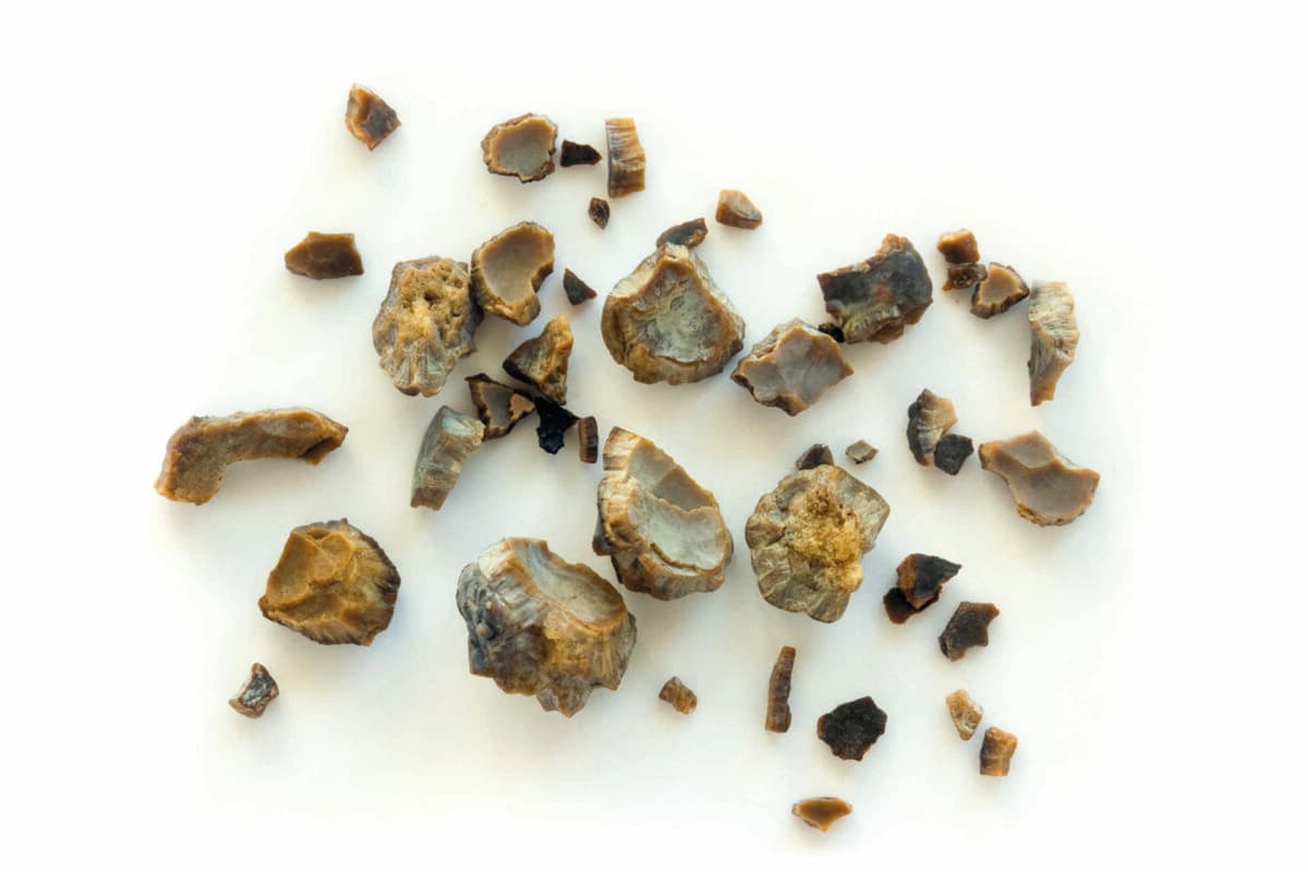 Kidney stones after ESWL intervention
