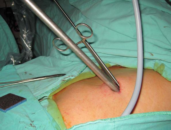 Die thorakoskopische Lobektomie zur chirurgischen Behandlung des Lungenkarzinoms