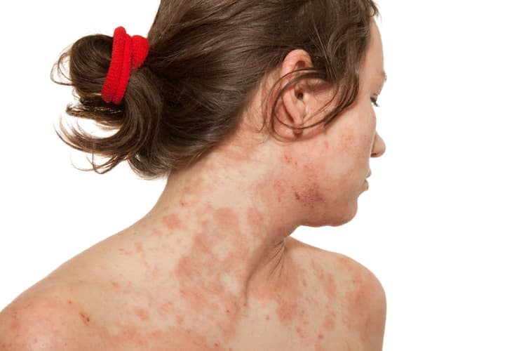 Atopische Dermatitis Altbewährtes und Neues